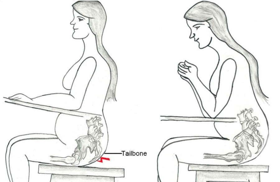 Боль в копчике при беременности лечение thumbnail