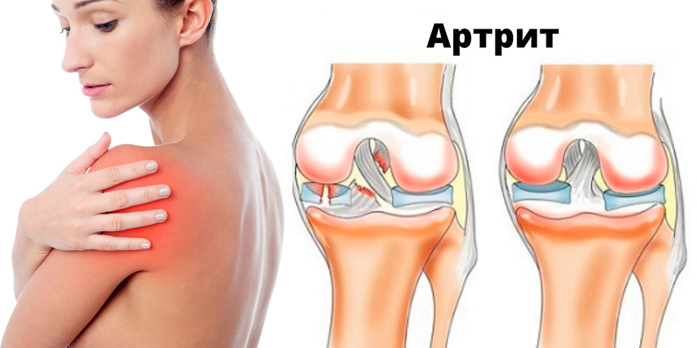 Лечение артрита суставов в домашних условиях. Плечелопаточный артериит. Посттравматический артрозо артрит. Артрозо-артрит плечевого сустава.