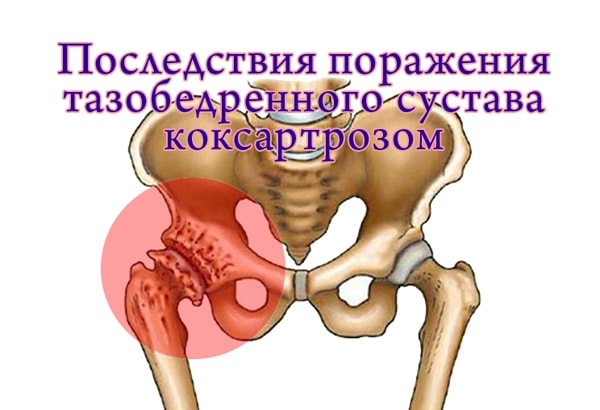 Патология тазобедренного сустава. Тазобедренный сустав. Заболевания тазобедренного сустава. Коксартроз тазобедренного сустава. Больной тазобедренный сустав.
